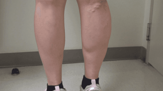 Legs with visible varicose veins