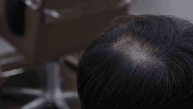 Crown of middle-aged man with white hair