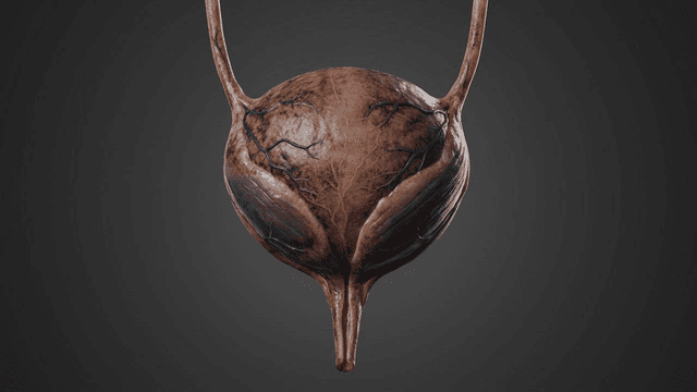 Detailed view of human bladder entering diseased state