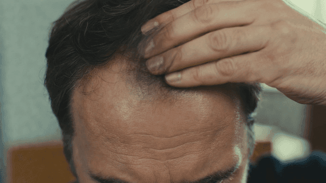 Middle-aged man touching his forehead, which is thinning with hair due to hair loss