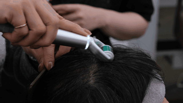 Beautician treating scalp with derma roller