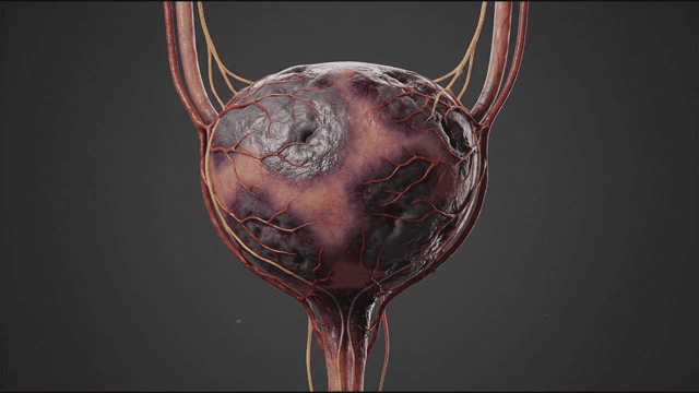 Detailed view of human bladder becoming diseased by virus