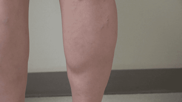 Calves of person with varicose veins