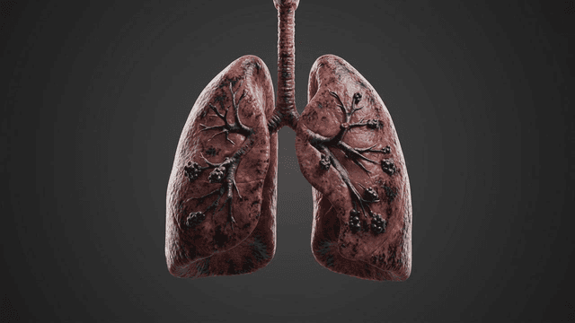 Detailed view of diseased human lung