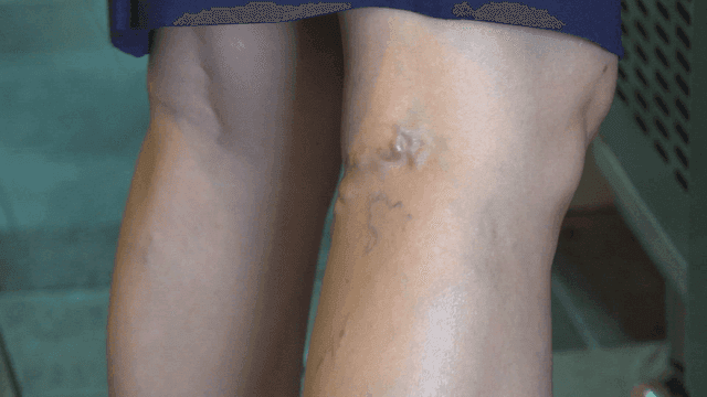 Person with clearly visible varicose veins on his or her legs