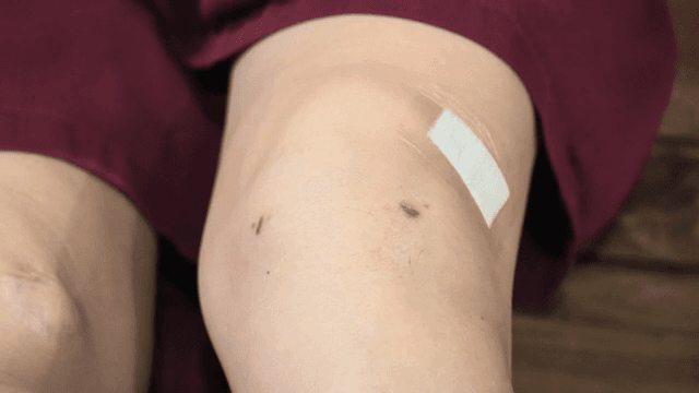 멍과 반창고가 있는 무릎