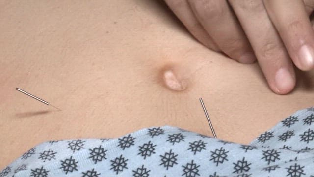 피부에 시술되는 침술 근접 촬영