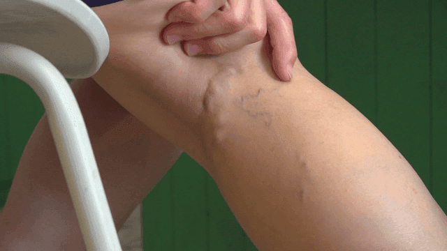 Person examining varicose veins on legs