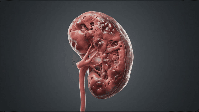 Detailed view of a kidney with disease progression