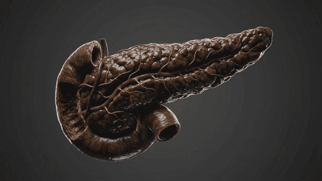Detailed view of model of diseased and darkening human pancreas