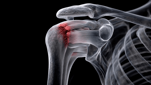 Detailed view of shoulder joint inflammation