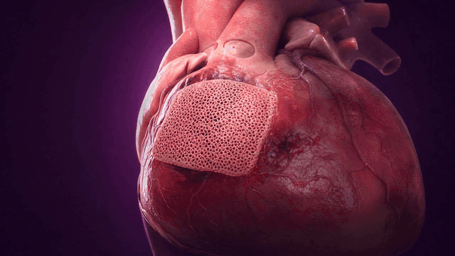 Human heart with surgical patch