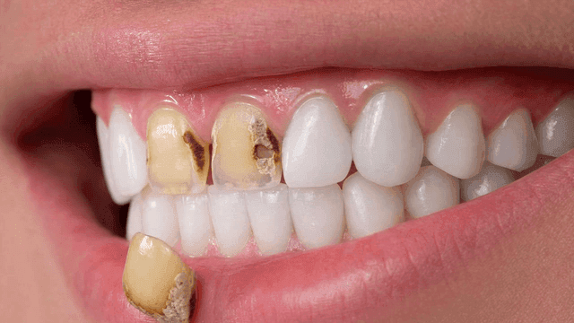 Front teeth falling out due to decay