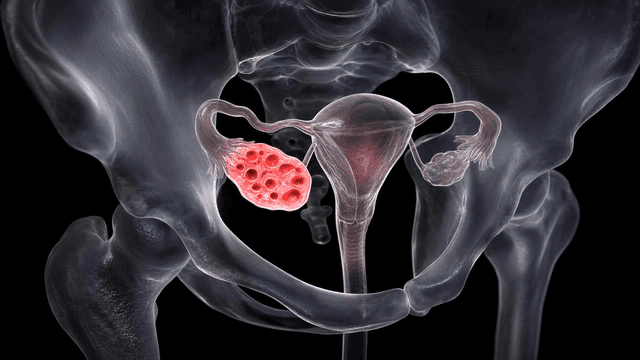 Detailed view of female reproductive organs with polycystic ovaries