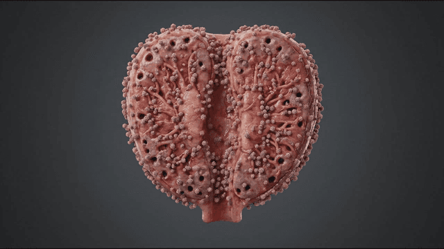 Prostate infected with virus