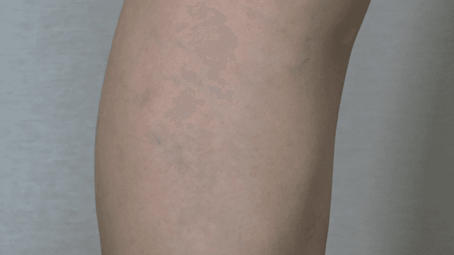 Legs with skin conditions that suggest varicose veins