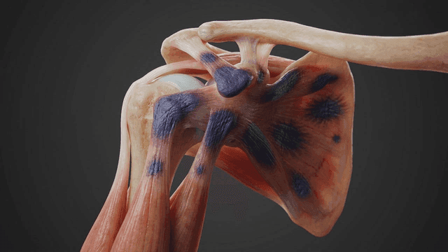 Detailed view of anatomy of diseased shoulder