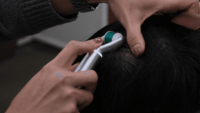 Scalp treatment using rollers