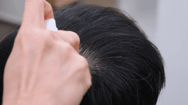 Scalp treatment with a roller device