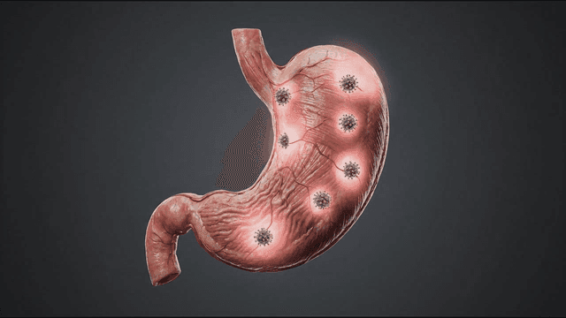 Stomach affected by bacteria