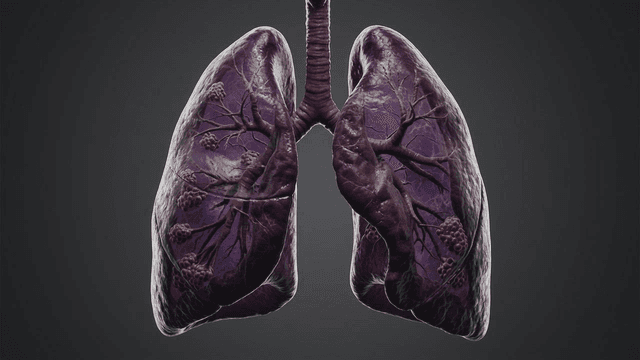 Detailed anatomical view of diseased human lung