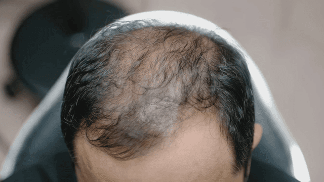 Close-up shot of crown of man's head after hair loss