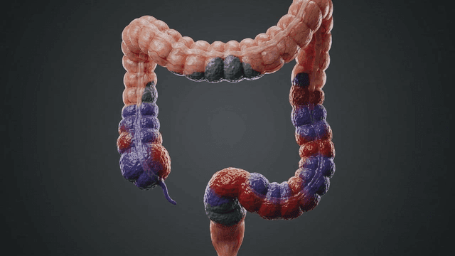 Detailed view of model of diseased human large intestine
