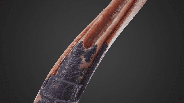 Detailed view of diseased human artery