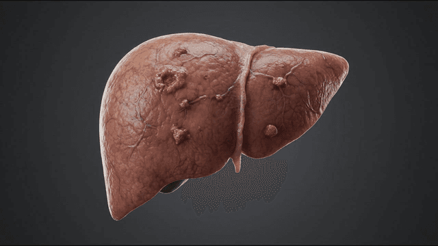 Progression of liver disease over time