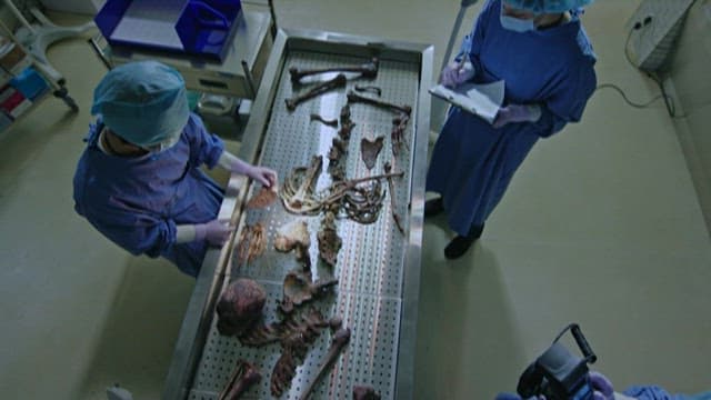 Medical Professionals Analyzing Burnt Skeletal Remains