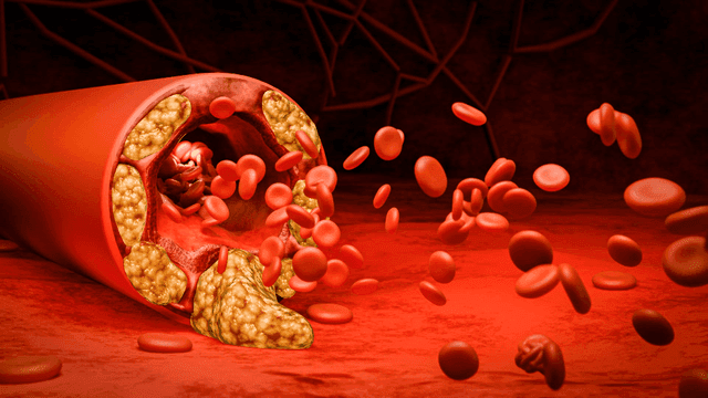 Red blood cells flowing through arteries covered in fat