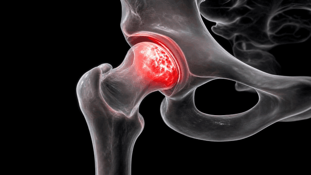 Detailed view of a hip joint with inflammation