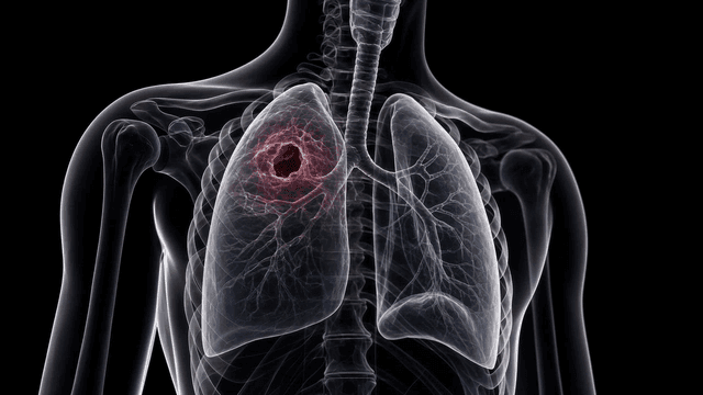 X-ray image of perforated lung with highlighted area
