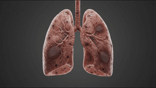Detailed view of human lungs with disease