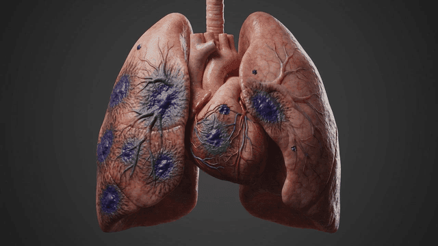 Human lungs with progressive infection