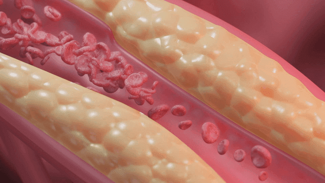 Red blood cells flowing through fatty arteries