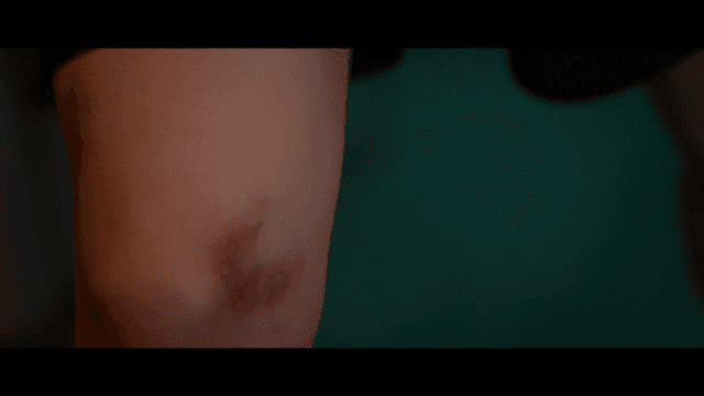 녹색 바닥 위의 멍든 무릎