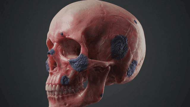 Diseased human skull