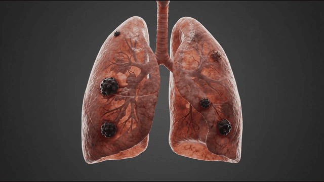 Detailed view of human lungs with tumors