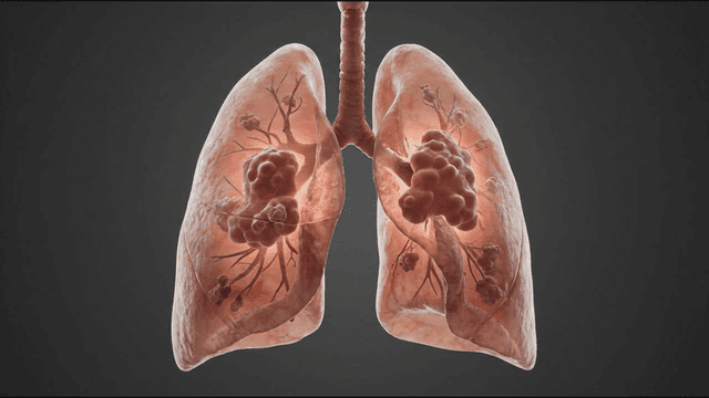 Detailed view of human lungs with growths