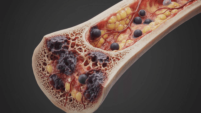 Detailed view of structure of diseased bone marrow
