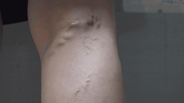 Patients with bulging varicose veins on their legs