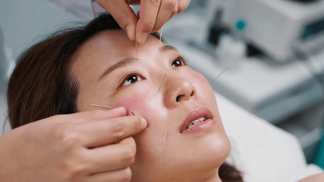 Korean medicine doctor who performs acupuncture on woman's face