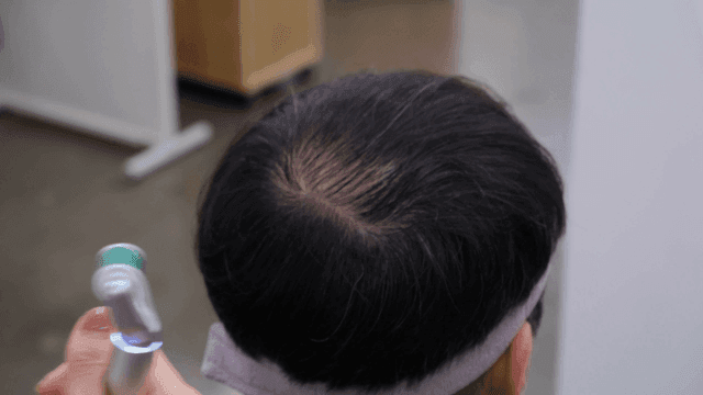 Scalp care using roller device