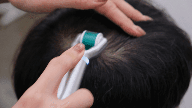 Scalp treatment with a roller device