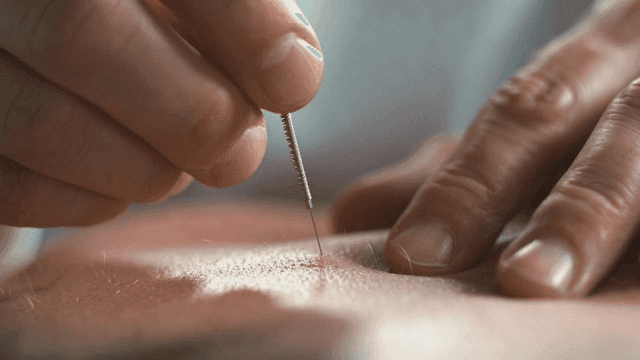 Hand of Korean medicine doctor inserting needles into skin