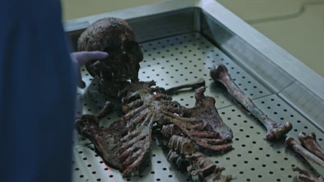 Medical Professionals Analyzing Burnt Skeletal Remains