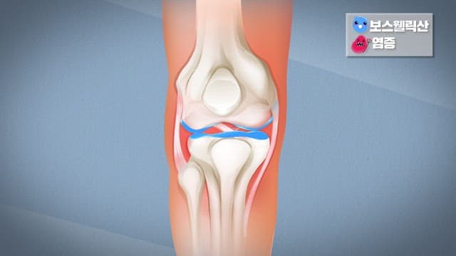 무릎 관절 메커니즘에 대한 애니메이션 설명