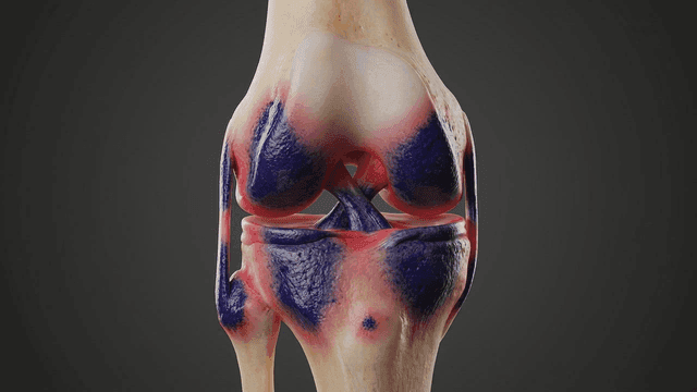 Infected knee joint