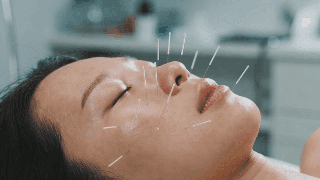 Acupuncture needles on a woman's face
